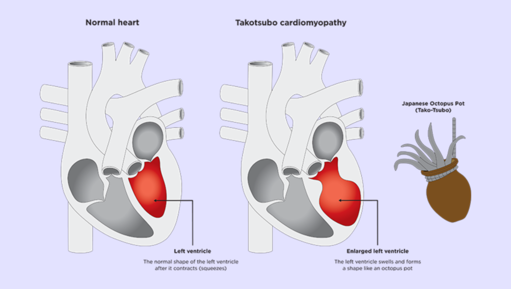 Takotsubo Cardiomyopathy